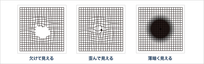 大阪府茨木市の眼科で黄斑疾患セルフチェック