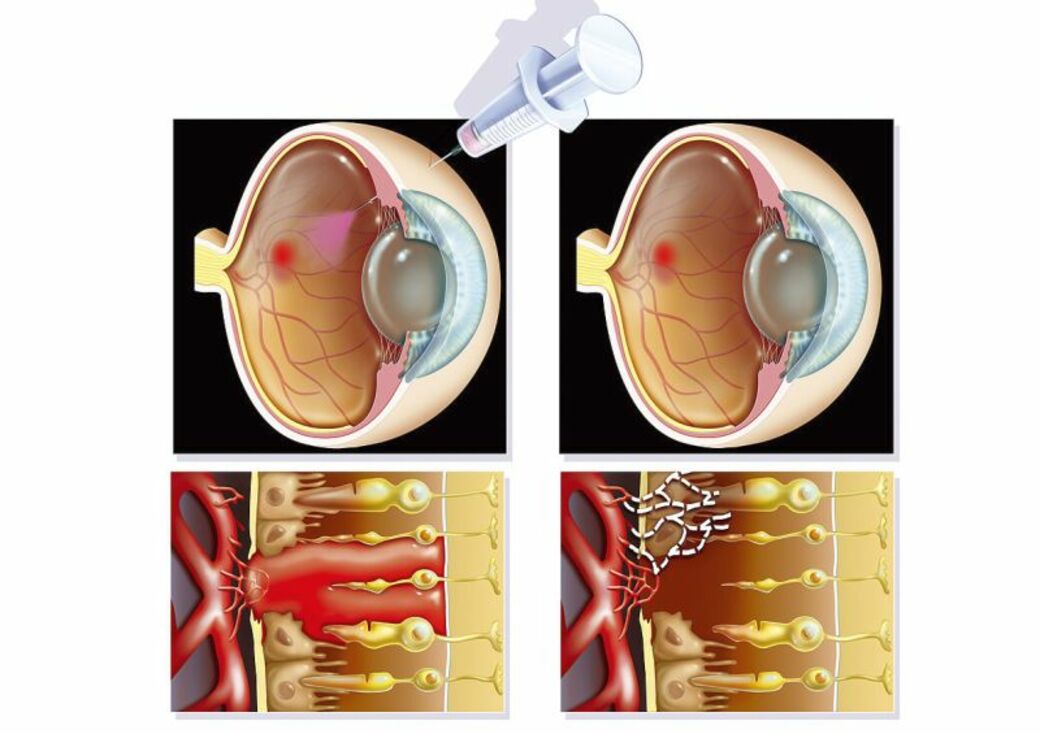 大阪府茨木市の眼科の黄斑疾患の専門治療