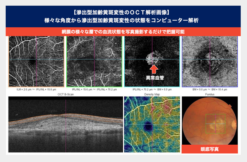 大阪府茨木市、永井眼科の3次元眼底検査