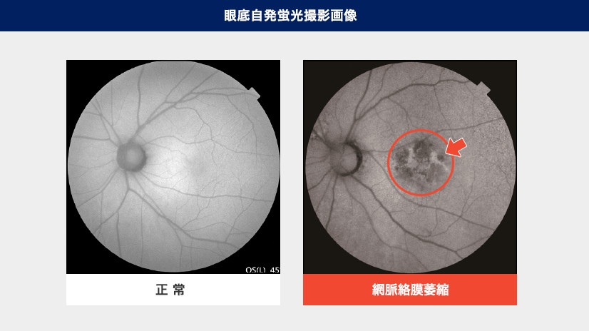 大阪府茨木市、永井眼科の3次元眼底検査
