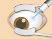 大阪府茨木市、永井眼科の黄斑疾患専門治療
