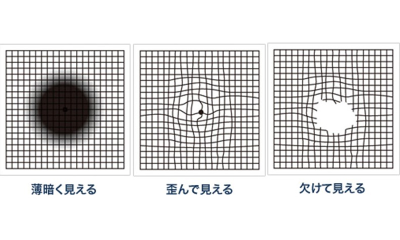 大阪府茨木市の眼科の黄斑疾患の治療