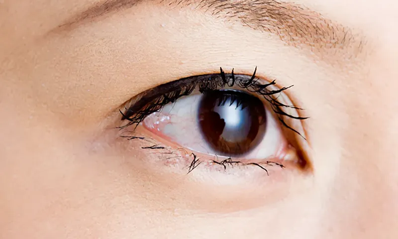 大阪府茨木市の眼科の糖尿病黄斑浮腫治療