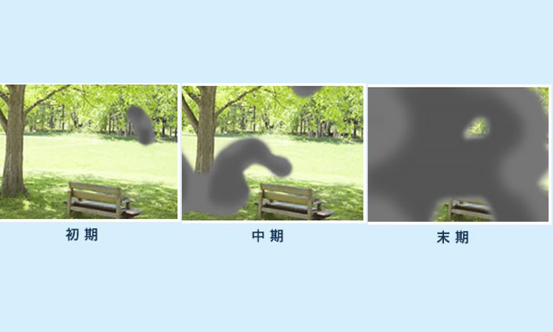 大阪府茨木市の眼科の緑内障治療