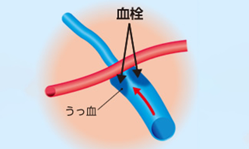 大阪府茨木市の眼科の網膜静脈閉塞症治療