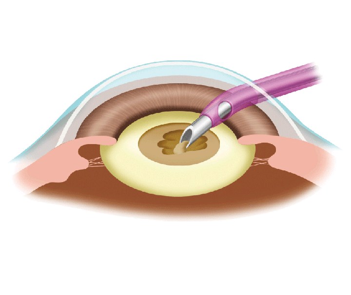 大阪府茨木市の眼科、永井眼科の白内障日帰り手術