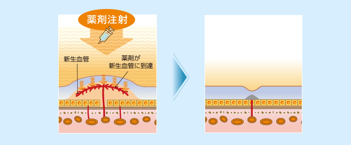 大阪府茨木市の眼科で黄斑疾患専門治療